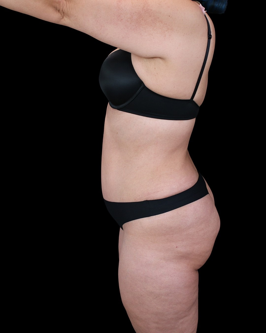 Tummy tuck before and after excess abdominal skin removal