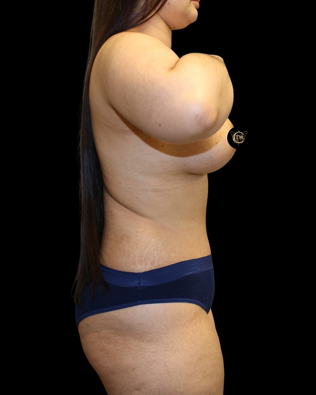 Abdominoplasty Before & After