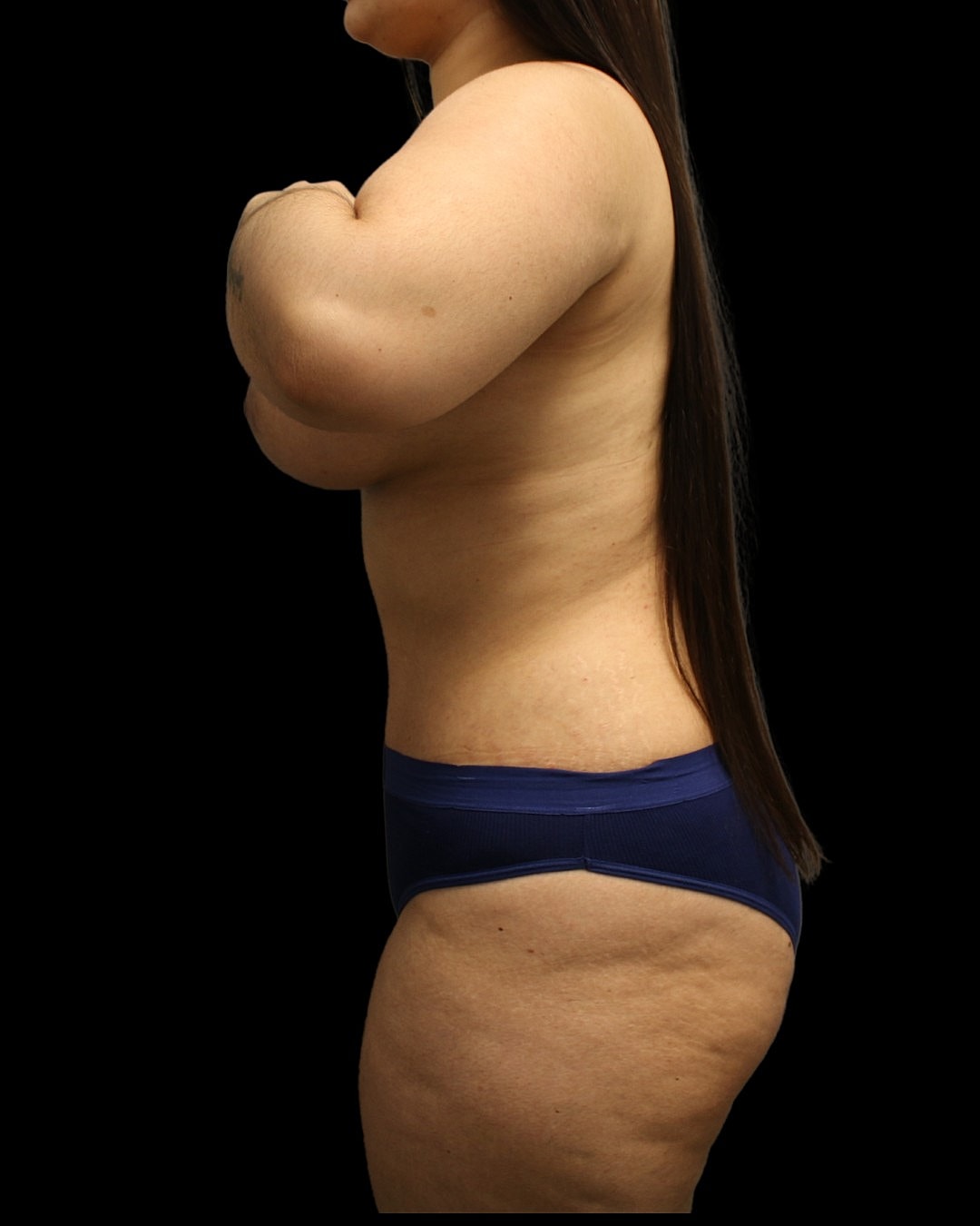 Abdominoplasty Before & After