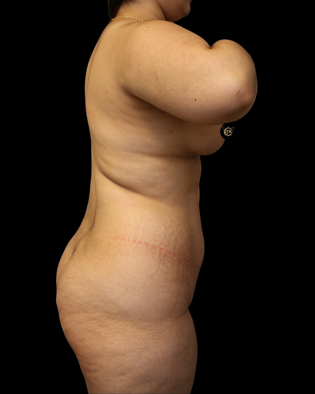 Abdominoplasty Before & After