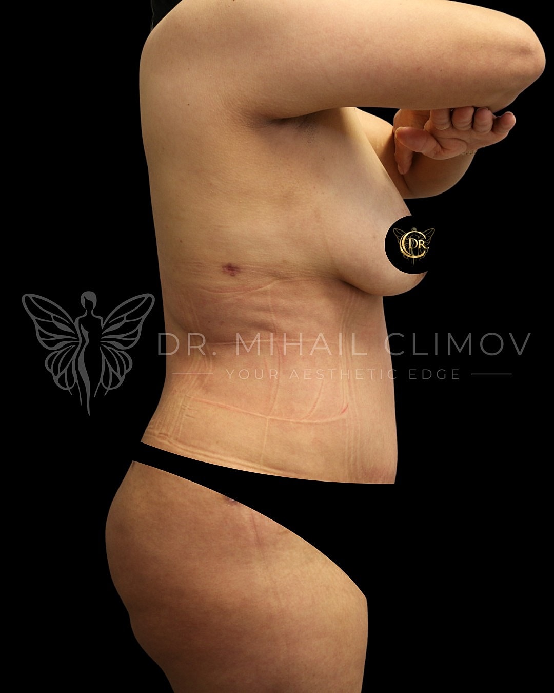 Abdominoplasty Before & After