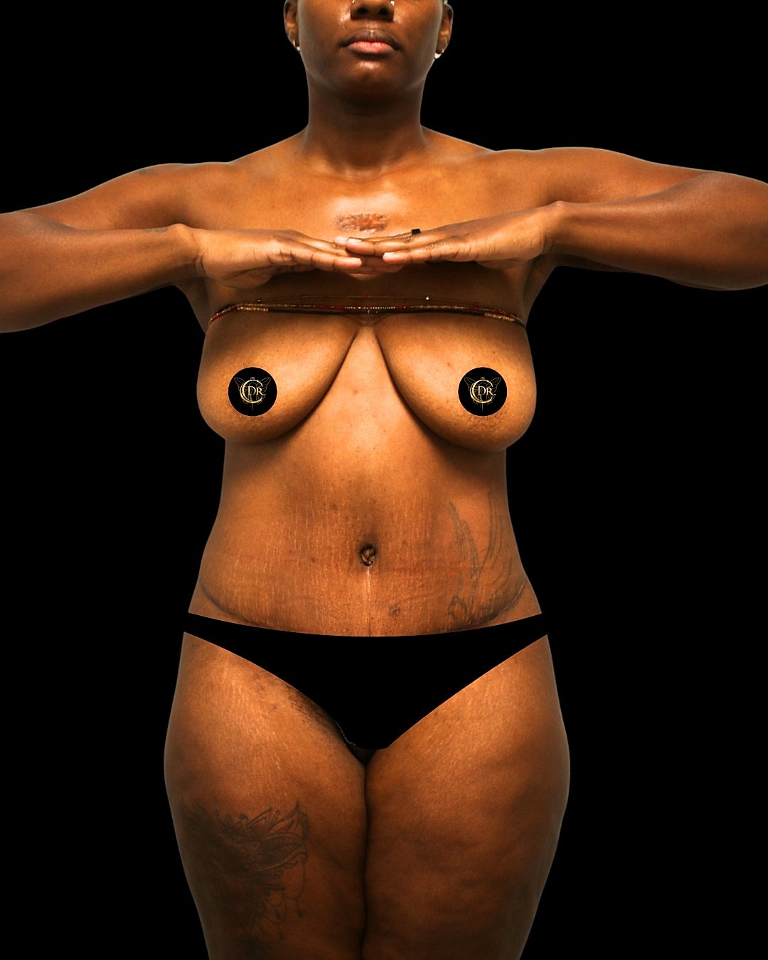 Abdominoplasty Before & After
