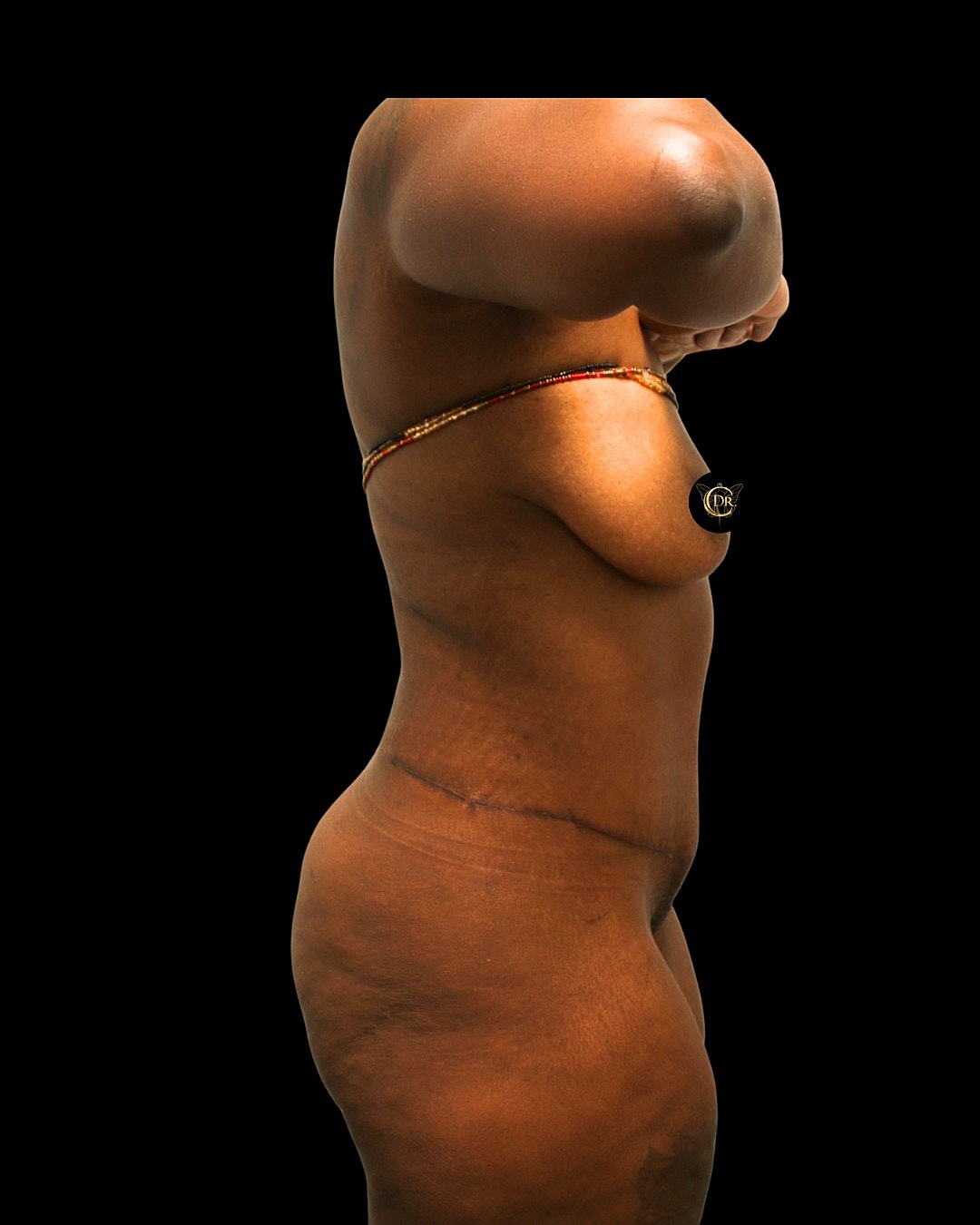 Abdominoplasty Before & After
