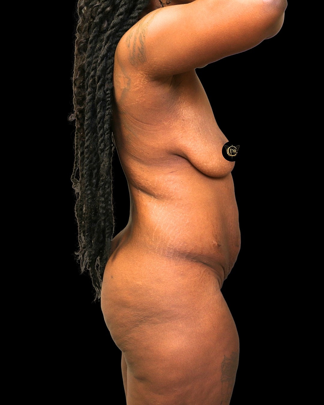 Abdominoplasty Before & After