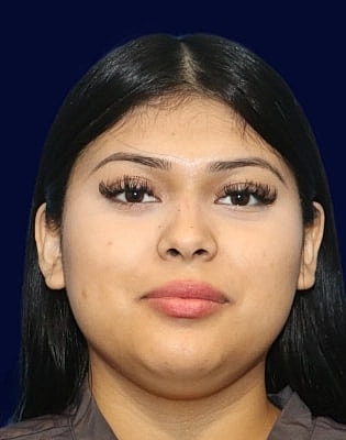 Neck Liposuction Before & After