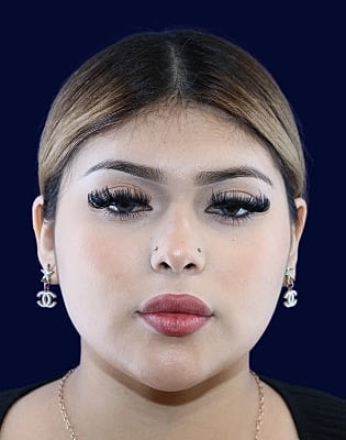 Neck Liposuction Before & After