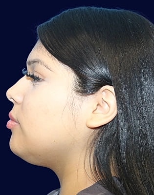 Neck Liposuction Before & After