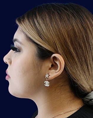 Neck Liposuction Before & After