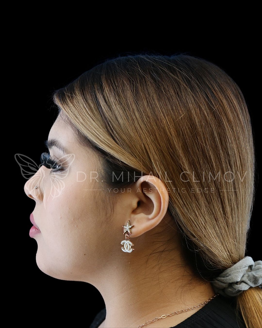 Female under-chin liposuction after photo, right side view, showing sculpted chin profile and smooth neck contour after neck contouring in Houston, Texas.