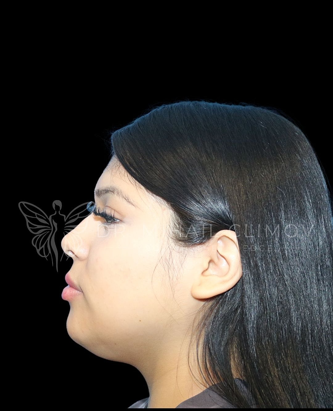 Female under-chin liposuction before photo, right side view, showing excess neck fat and rounded chin profile prior to neck contouring in Houston, Texas.