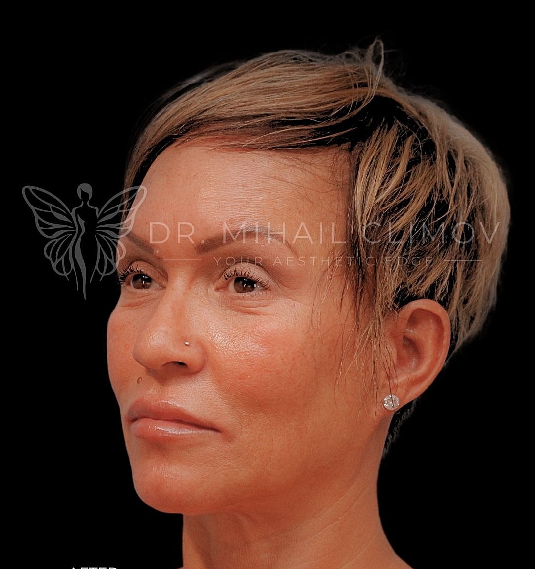 Female submental liposuction after photo, right oblique view, showing eliminated double chin and sculpted jaw profile after neck liposuction in Houston.