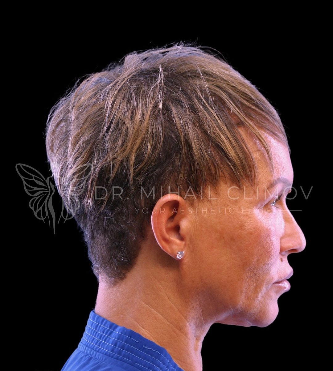 Female submental lipo after photo, left side view, showing sharp cervicomental angle and refined neck profile following chin liposuction in Houston, Texas.