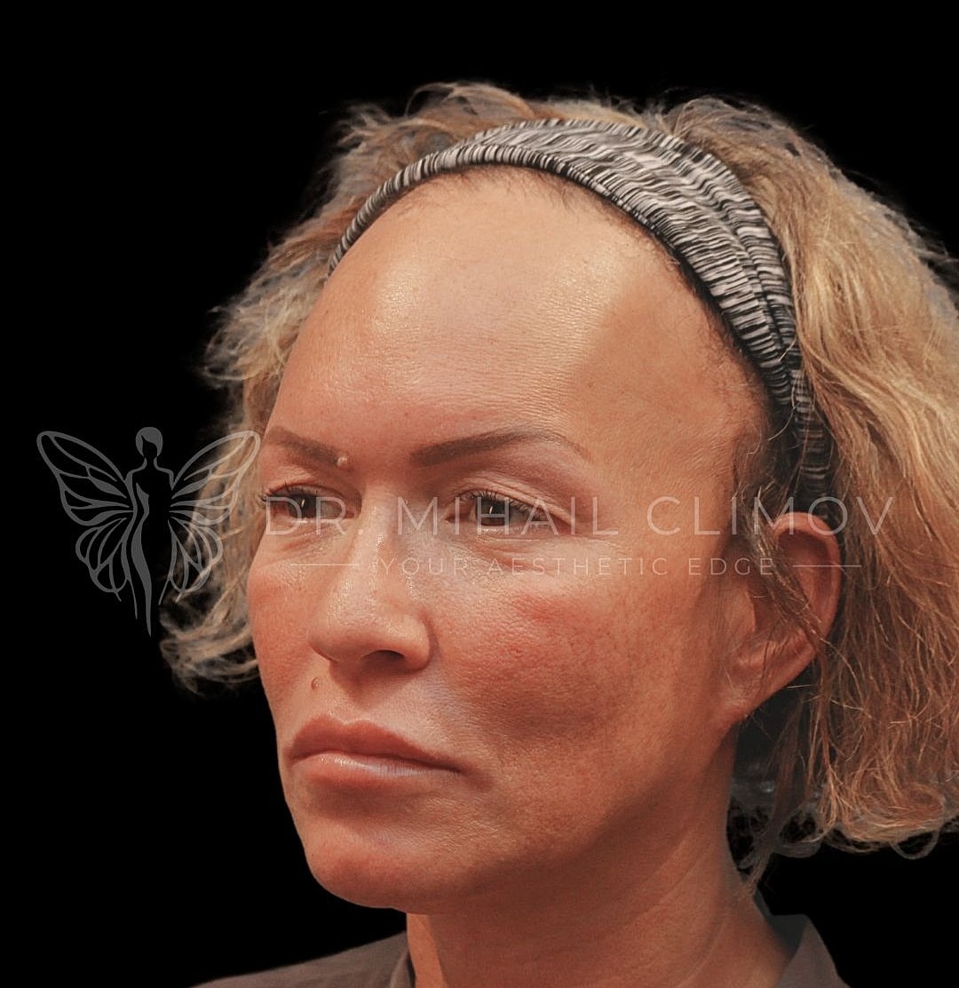 Female submental liposuction before photo, right oblique view, showing double chin and excess submental fat prior to neck liposuction in Houston.