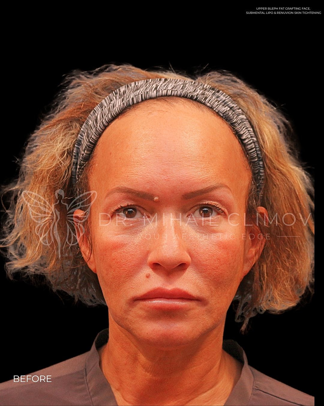 Female submental liposuction before photo, front view, showing fullness under the chin and undefined jawline prior to cosmetic neck contouring in Houston, TX.