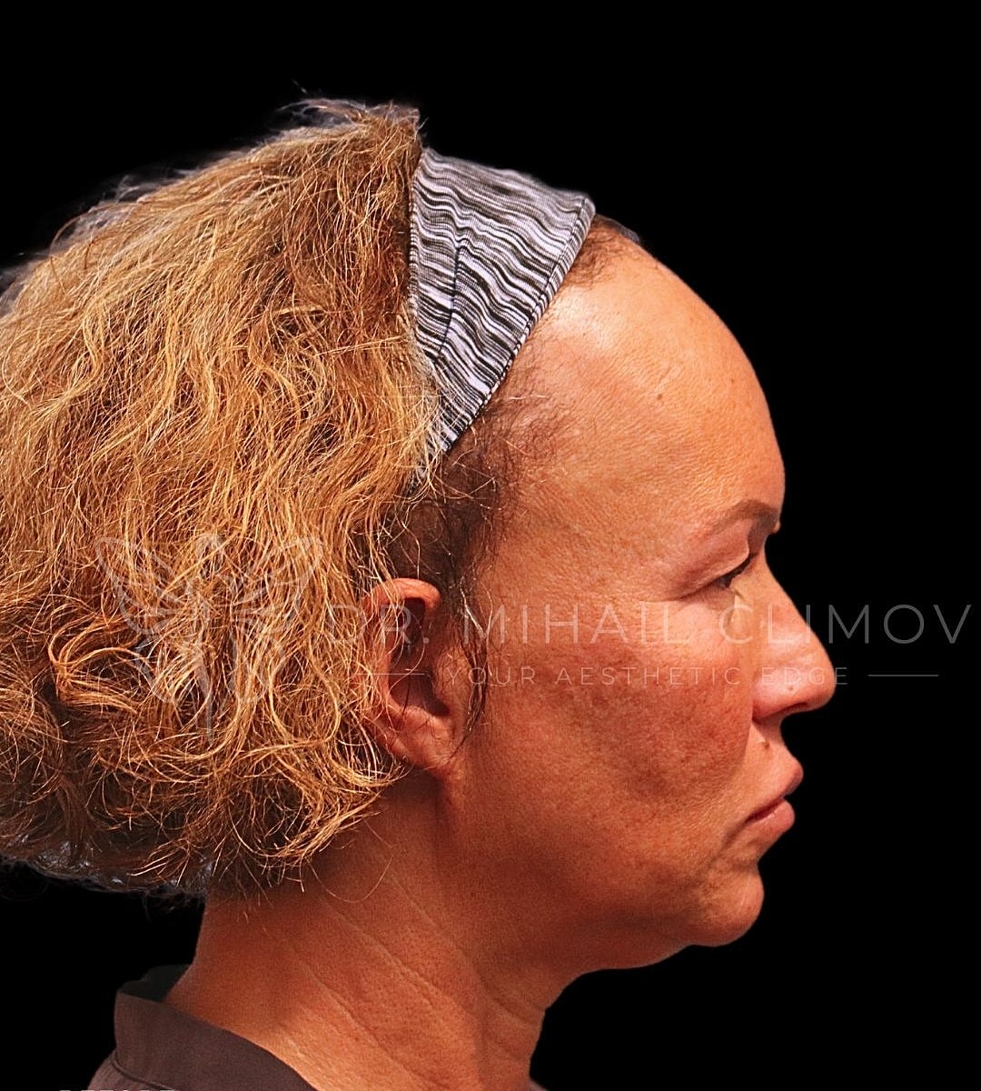 Female submental lipo before photo, left side view, showing heavy neck profile and lack of jaw definition prior to chin liposuction in Houston, TX.