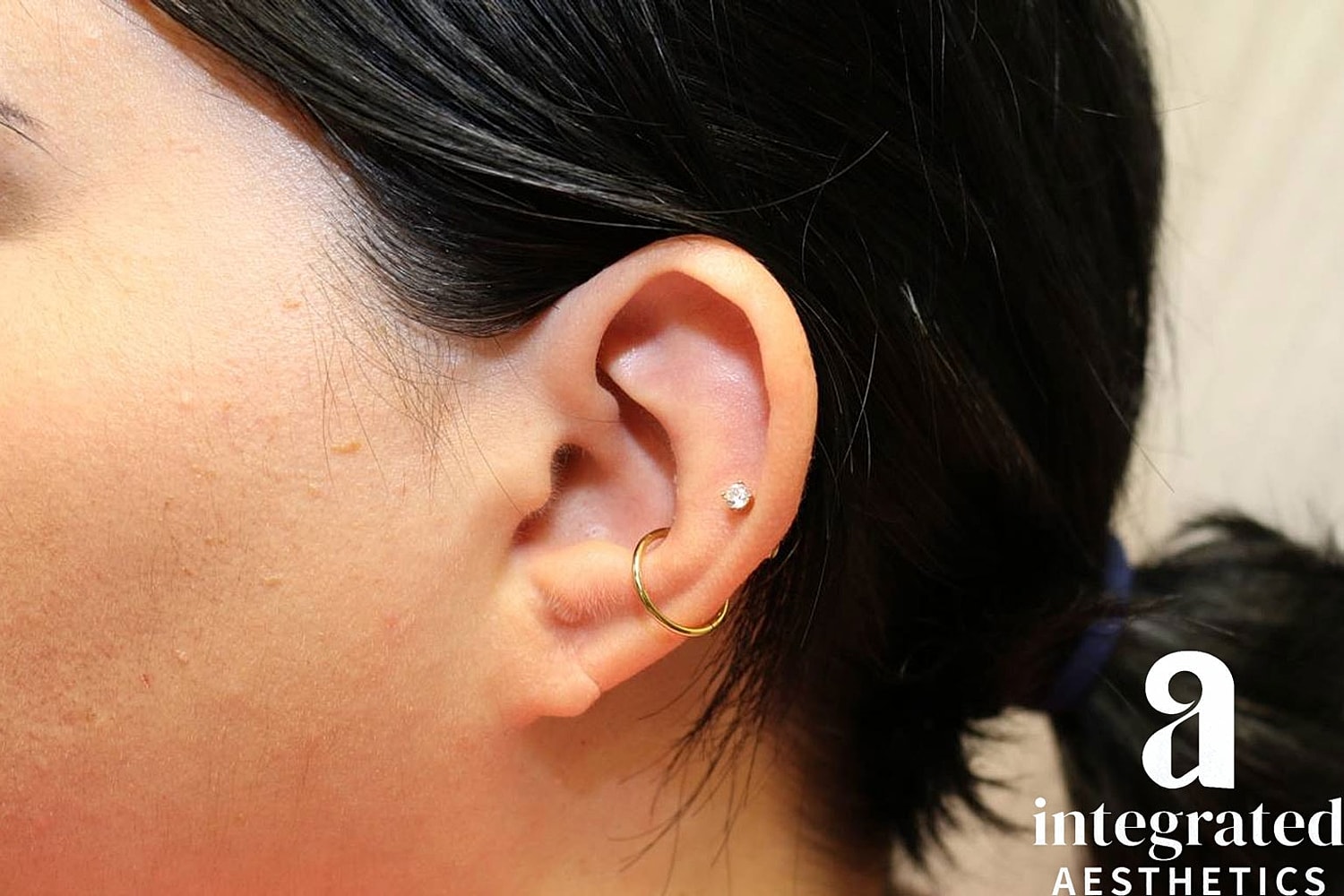 Earlobe Repair Before & After