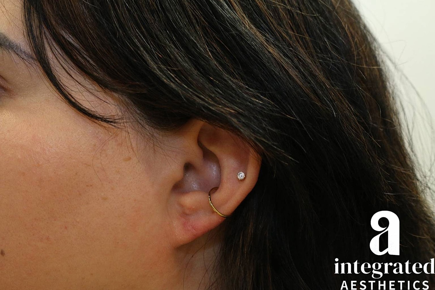 Earlobe Repair Before & After