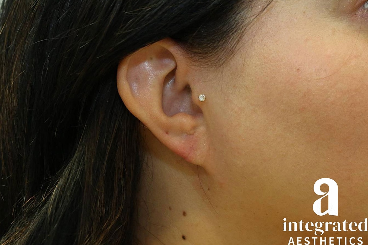 Earlobe Repair Before & After