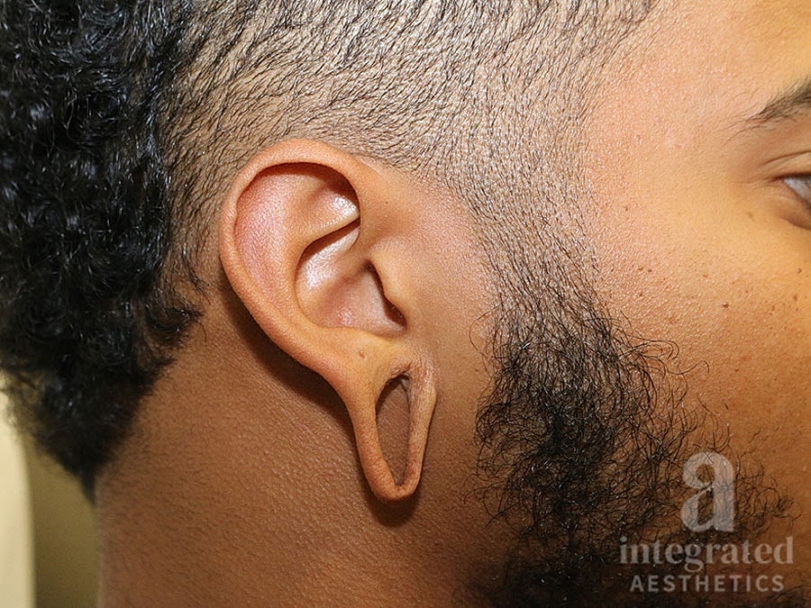 Earlobe Repair Before & After