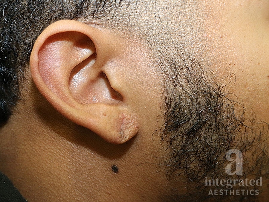 Earlobe Repair Before & After
