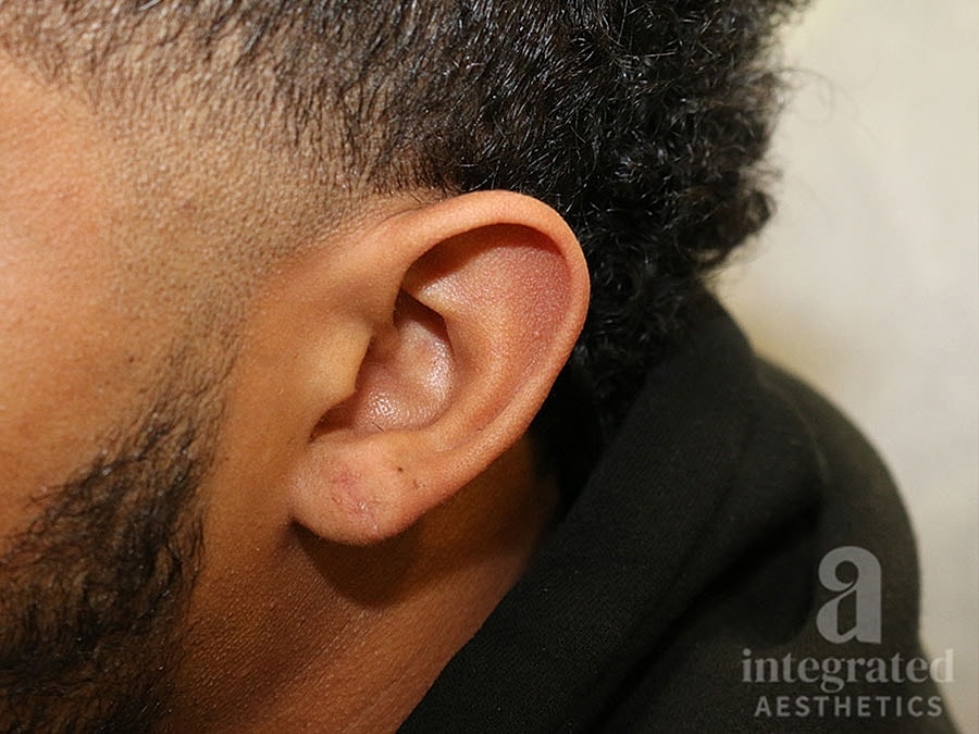 Earlobe Repair Before & After