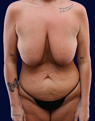 Mommy Makeover Before & After