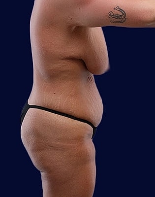 Mommy Makeover Before & After