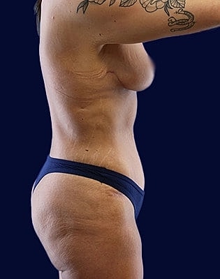 Mommy Makeover Before & After