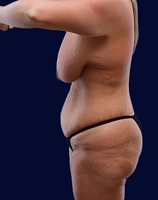 Mommy Makeover Before & After