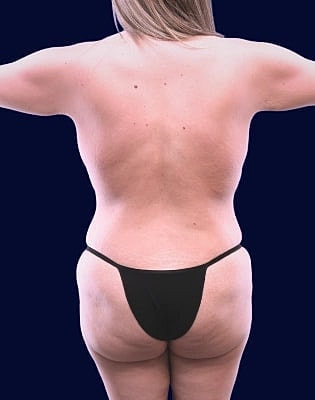 Mommy Makeover Before & After