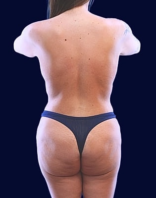 Mommy Makeover Before & After