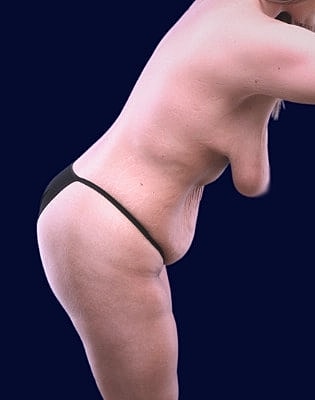 Mommy Makeover Before & After