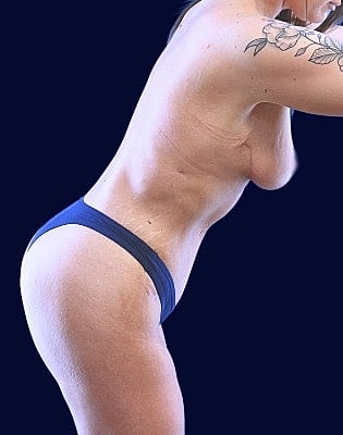 Mommy Makeover Before & After