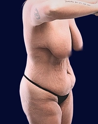 Mommy Makeover Before & After