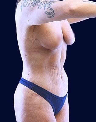 Mommy Makeover Before & After