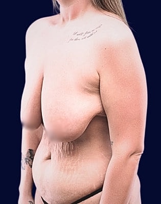 Mommy Makeover Before & After