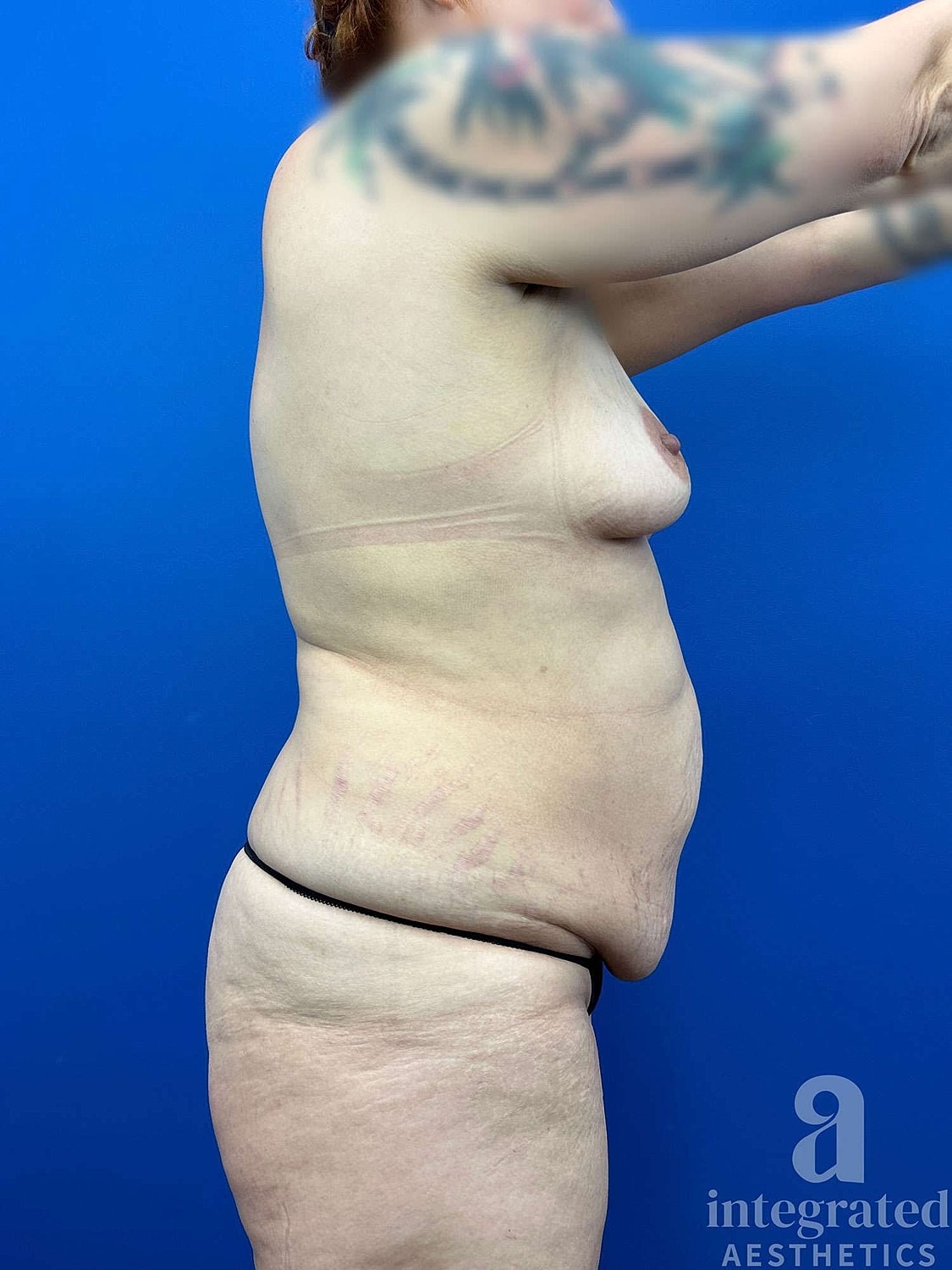 Mommy Makeover Before & After