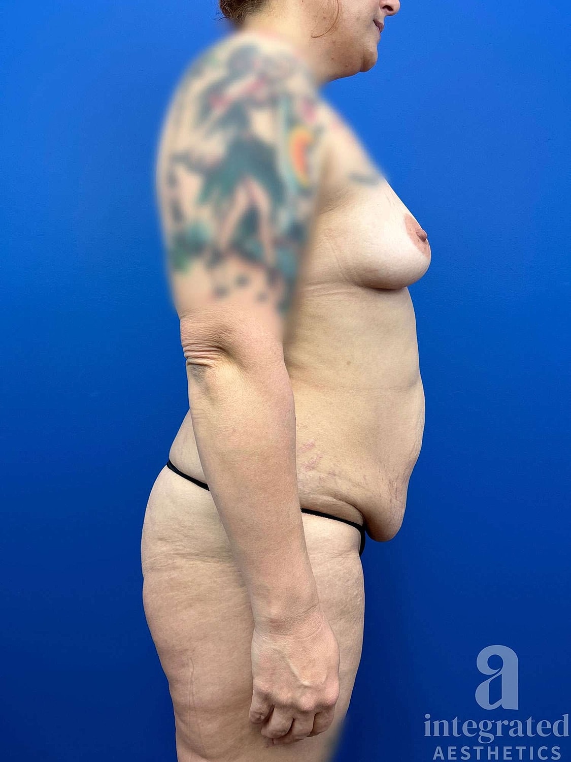 Mommy Makeover Before & After