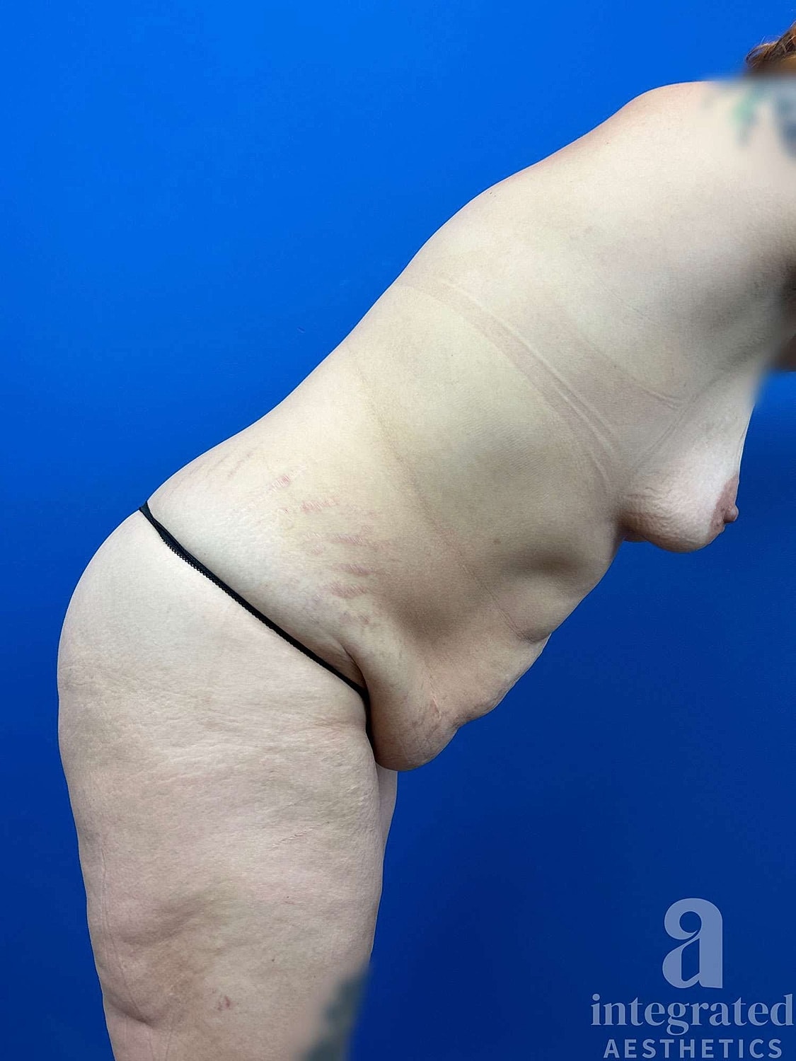 Mommy Makeover Before & After