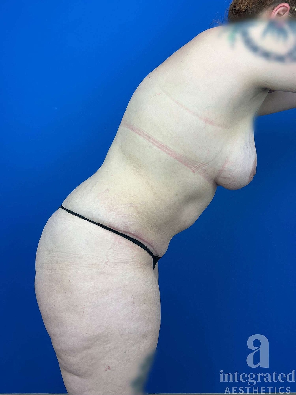 Mommy Makeover Before & After