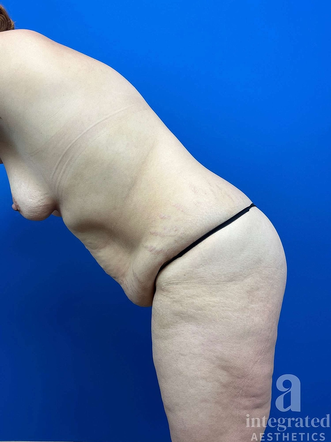 Mommy Makeover Before & After