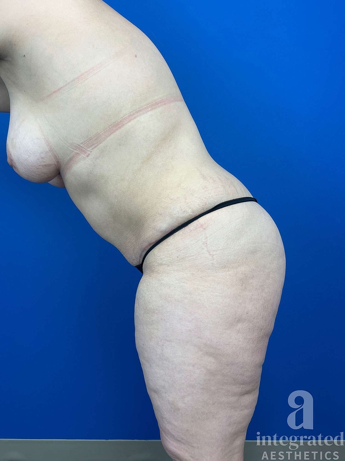 Mommy Makeover Before & After