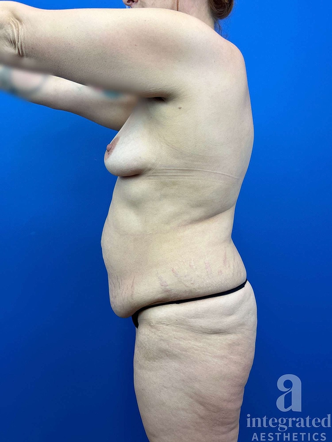 Mommy Makeover Before & After