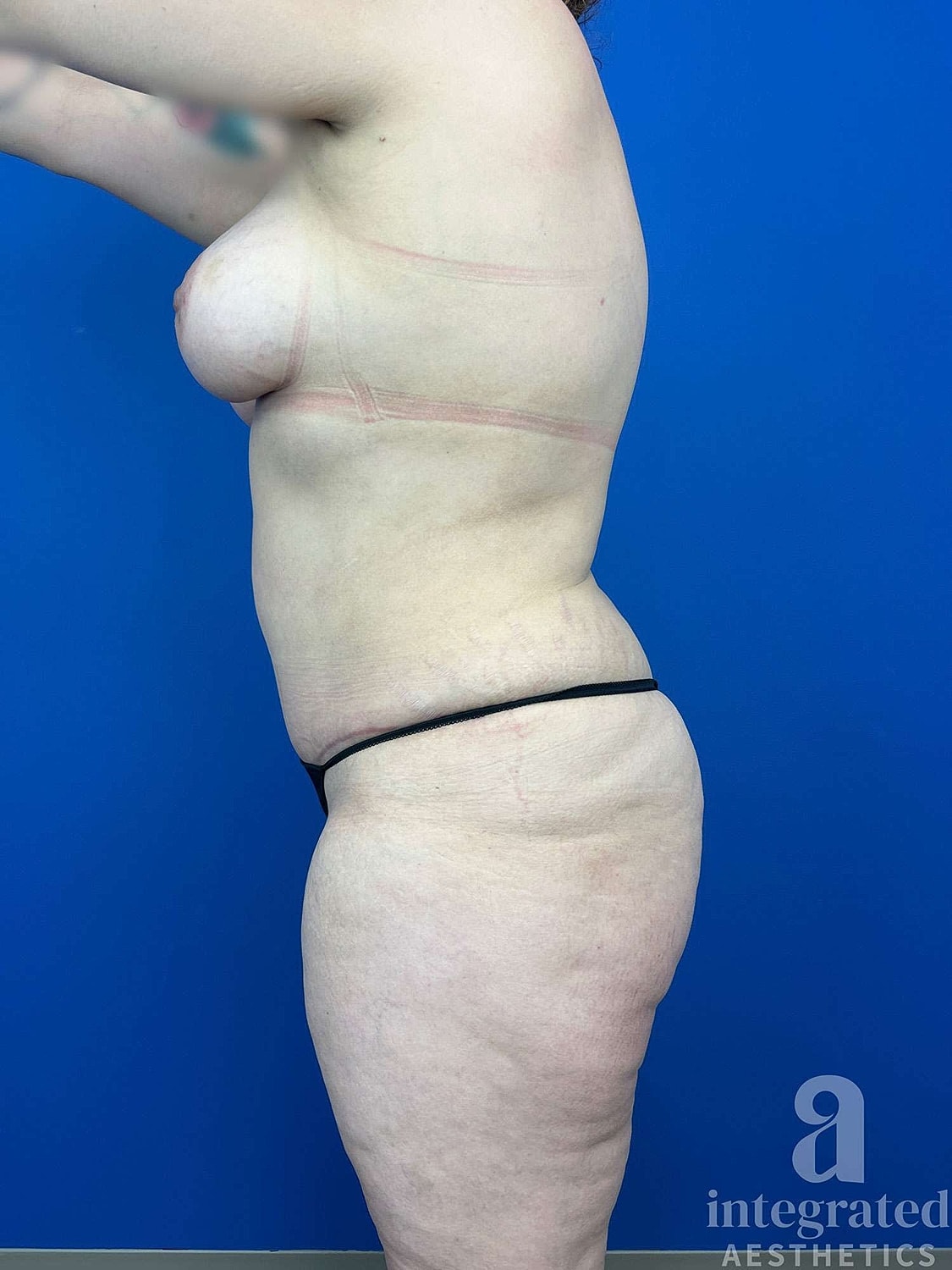 Mommy Makeover Before & After