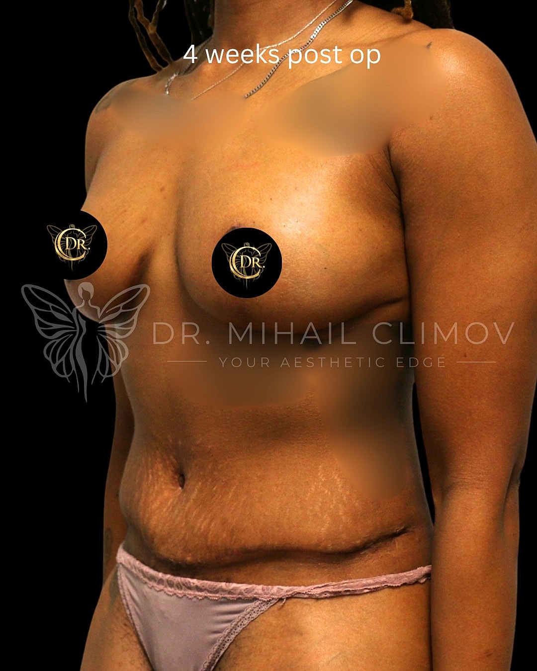 Case_008_after_3_4.png After mommy makeover results at 4 weeks post-op – 3/4 angle view – Dr. Mihail Climov, Aesthetic Plastic Surgeon, Houston, TX