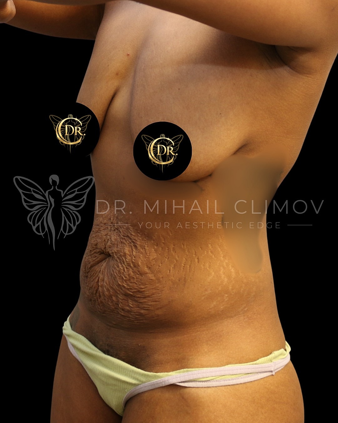 Case_008_Before_3_4.png Before mommy makeover surgery – 3/4 angle view – Dr. Mihail Climov, Aesthetic Plastic Surgeon, Houston, TX