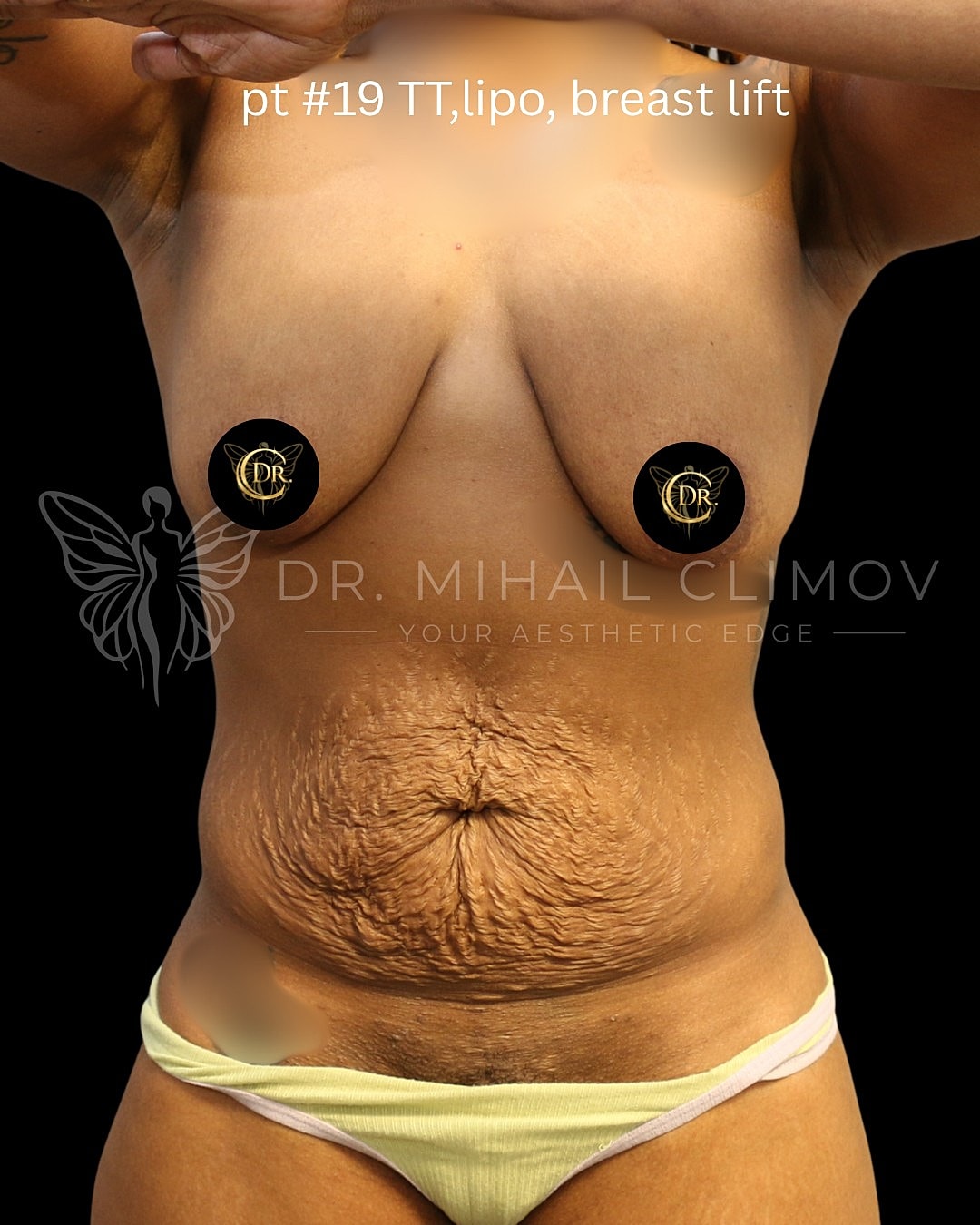 Case_008_Before_front.png Before mommy makeover surgery – front view – Dr. Mihail Climov, Aesthetic Plastic Surgeon, Houston, TX