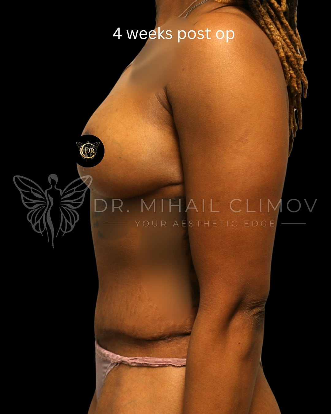 Case_008_left_after.png After mommy makeover results at 4 weeks post-op – left side profile view – Dr. Mihail Climov, Aesthetic Plastic Surgeon, Houston, TX