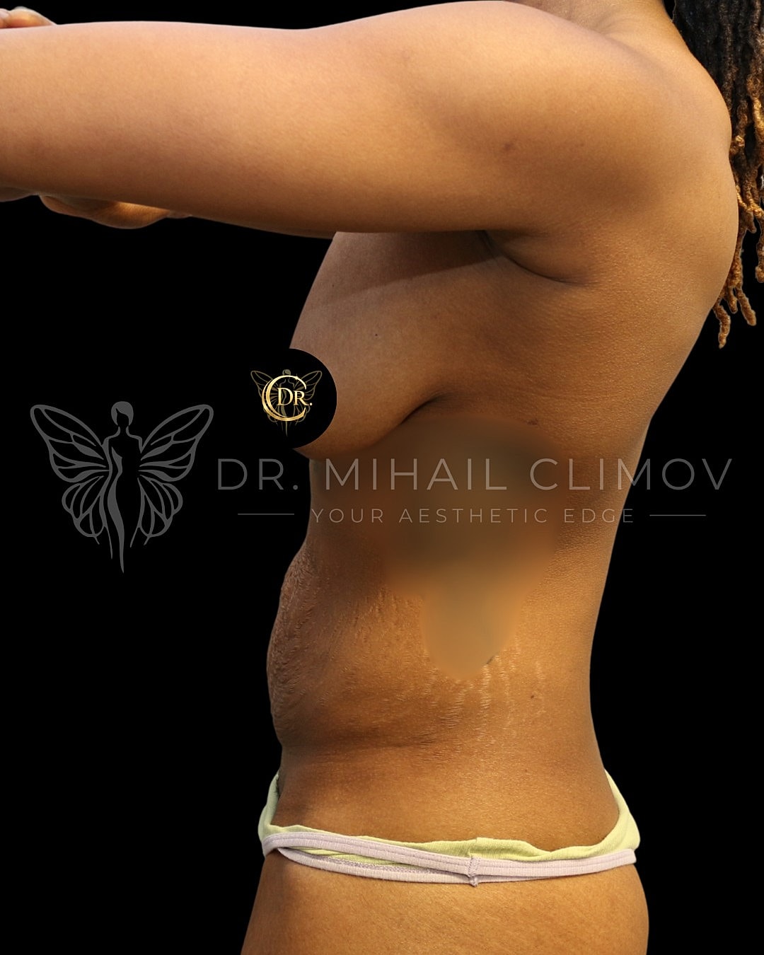 Case_008_left_before.png Before mommy makeover surgery – left side profile view – Dr. Mihail Climov, Aesthetic Plastic Surgeon, Houston, TX
