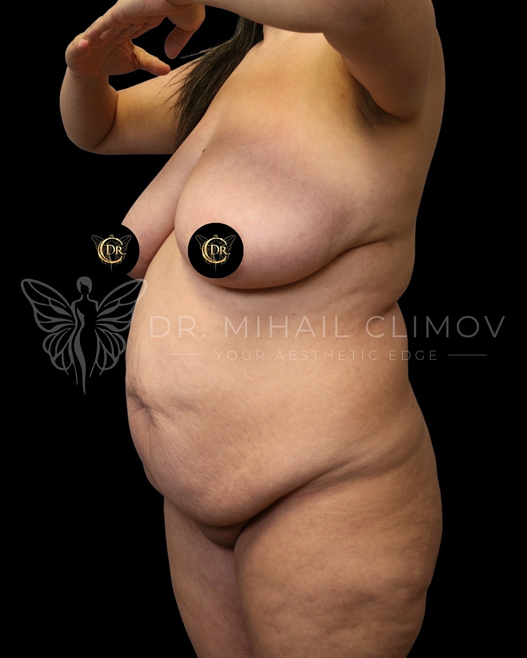 Case_011_3_4_before.png Before mommy makeover surgery – 3/4 angle view – Dr. Mihail Climov, Aesthetic Plastic Surgeon, Houston, TX